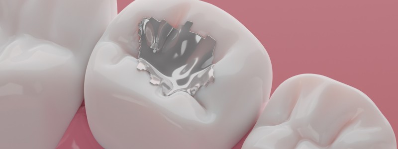 What Are Cosmetic Fillings?
