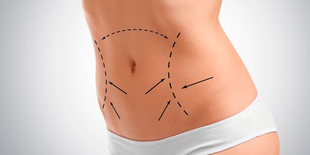 Minimally Invasive Fat Removal: VASER Liposuction in Riyadh