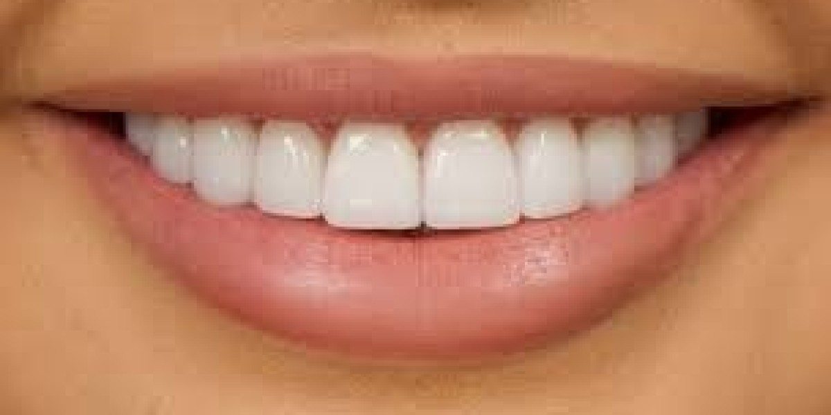 Transform Your Teeth: Dental Veneers in Riyadh Explained