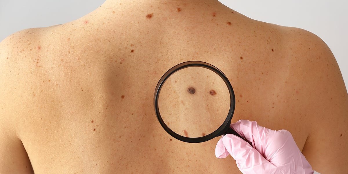 Can Mole Removal Be Done Safely at Any Age?