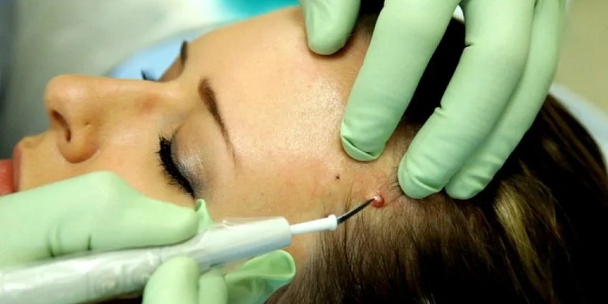 Warts Removal for Clearer Skin in Dubai