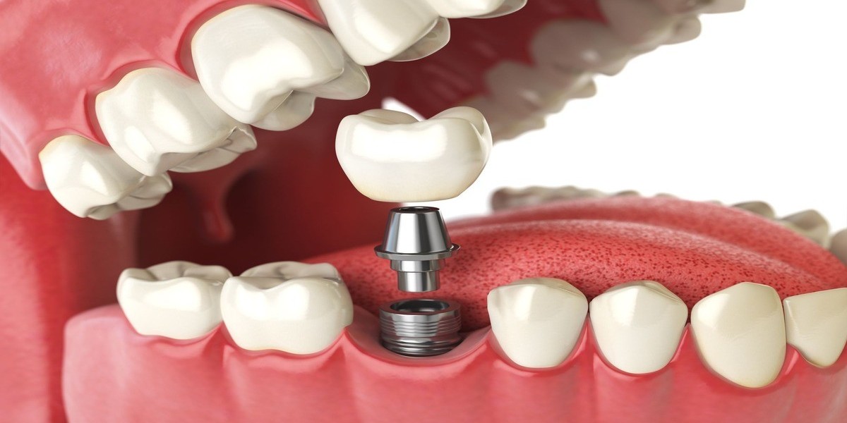 Dental Clinic & Implant Center in Indore