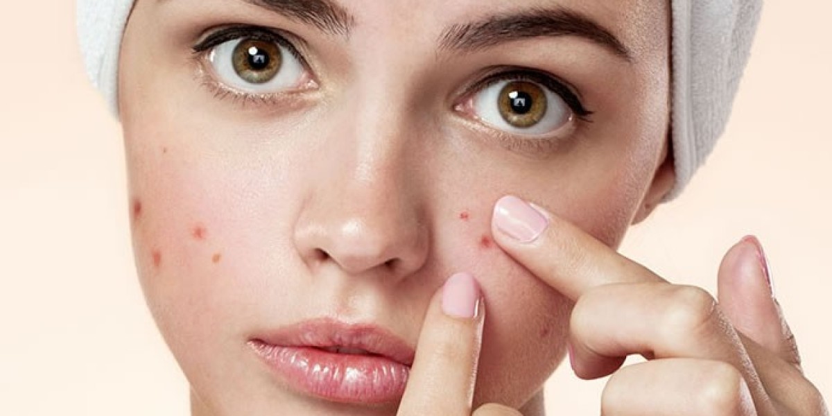 Pimples Treatment Costs and Options in Riyadh