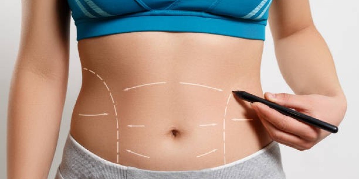 Understanding the Process of Tummy Tuck Surgery in Riyadh