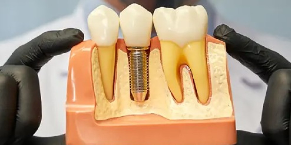 Dental implants in Al ain | Darqoon