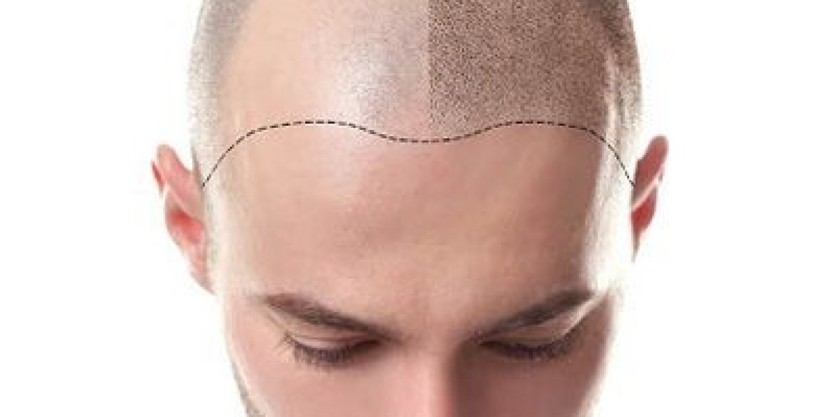 زراعة الشعر في الرياض: استثمار في مظهرك