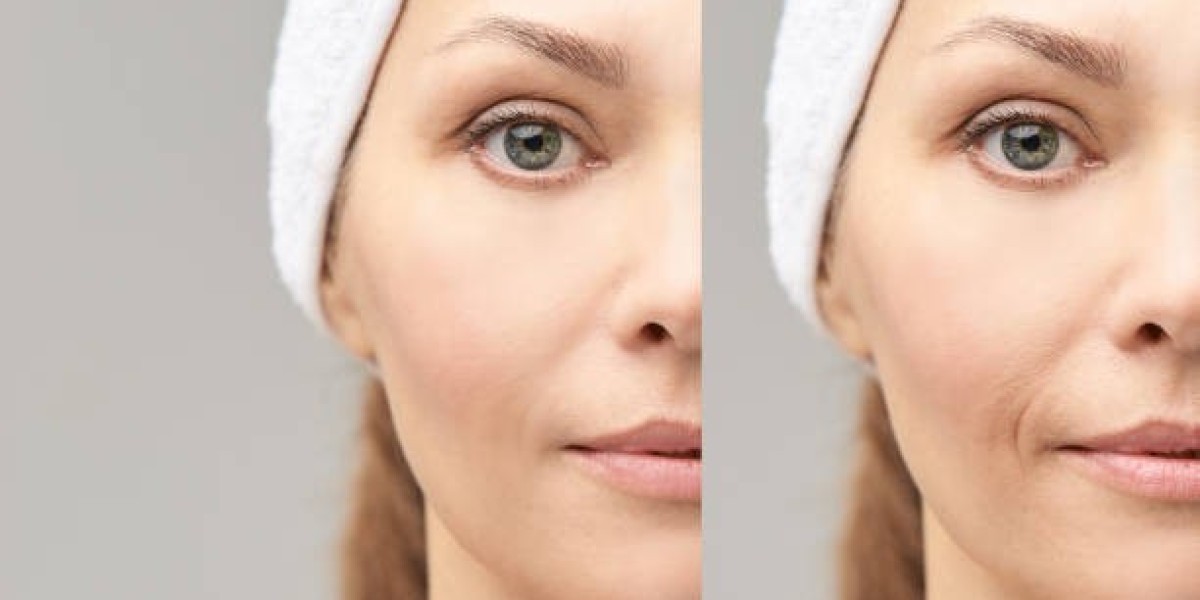 The Power of Glutathione Injections in Riyadh Explained