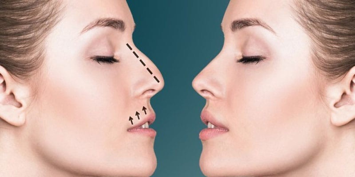 "Expert Rhinoplasty in Riyadh: Achieve the Nose You’ve Always Wanted"
