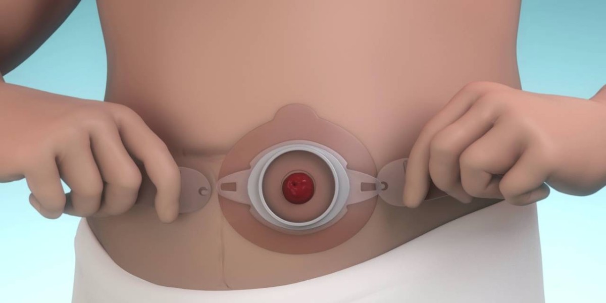 Ostomy Devices Market: Key Inhibitors Impacting Growth and Accessibility