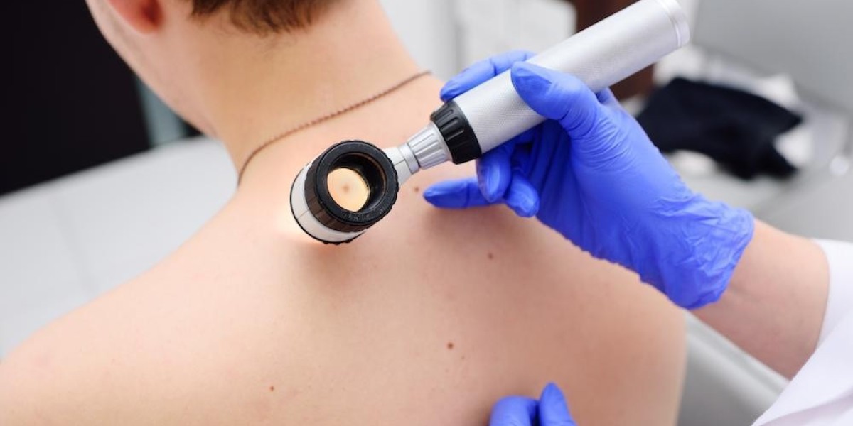 Which facial is best for acne scars?