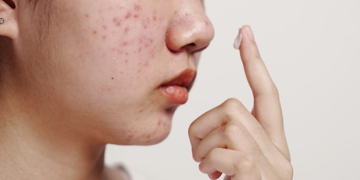 How to Maintain Clear Skin After Acne Treatment
