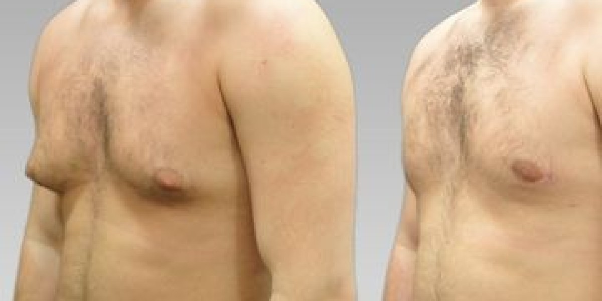 A Closer Look at Male Chest Reduction Options