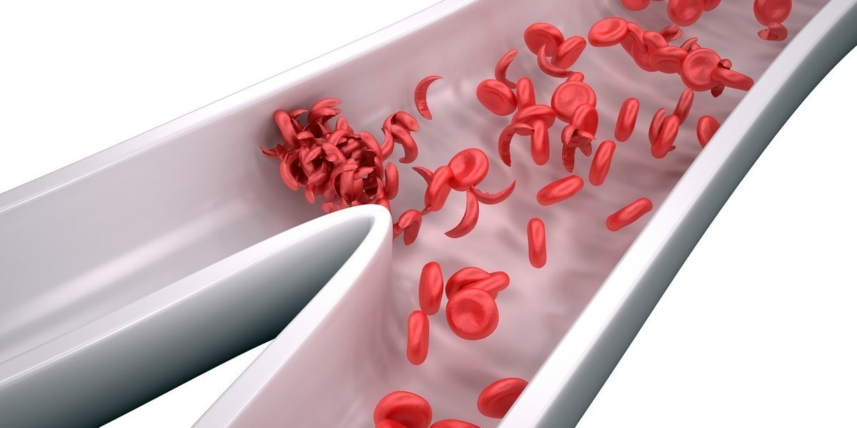 Sickle Cell Disease Treatment: The Impact of Clinical Trials and New Research