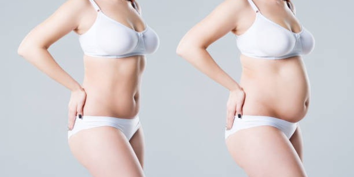 The Journey to a Sleeker Silhouette with Tummy Tuck Surgery in Riyadh