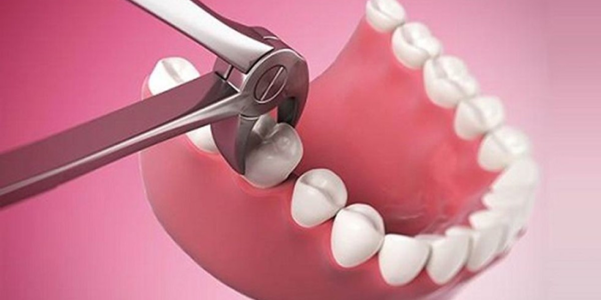 Có nên nhổ răng khôn không? Lời khuyên từ chuyên gia nha khoa