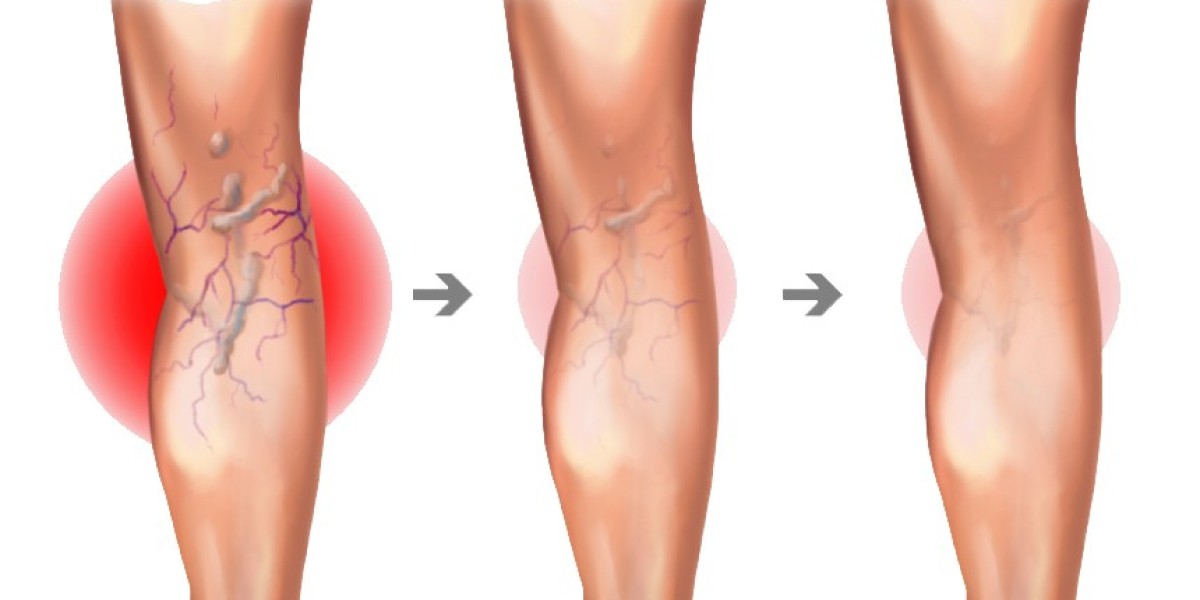 Cosmetic Solutions for Varicose Veins in Riyadh