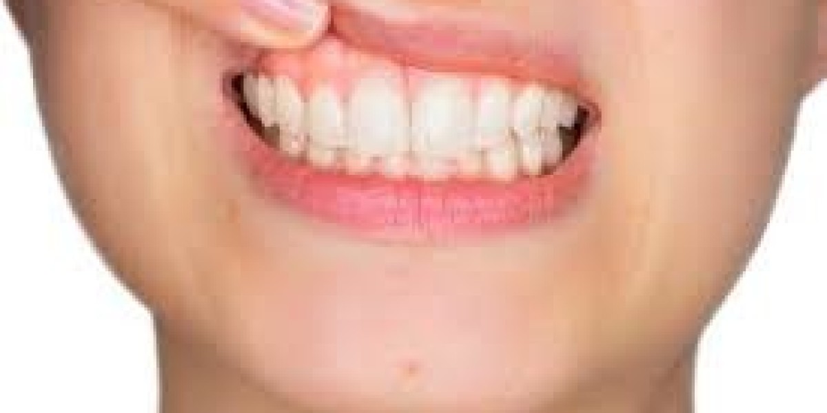 How Gum Contouring in Riyadh Can Enhance Your Facial Aesthetics