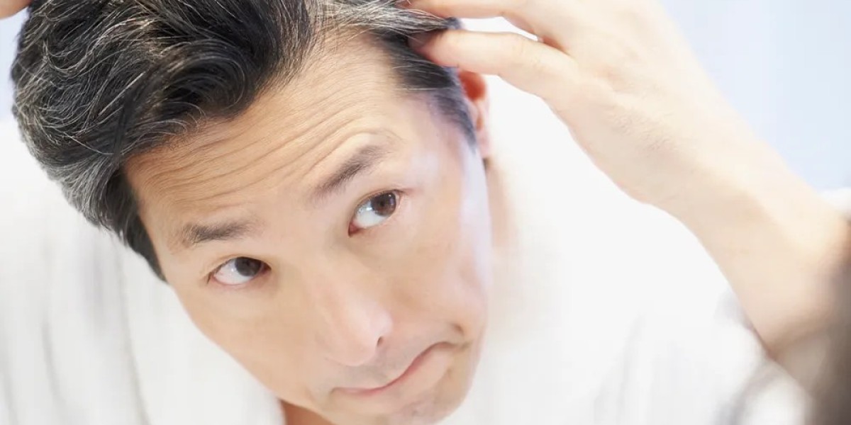 What is the age limit for hair transplants?