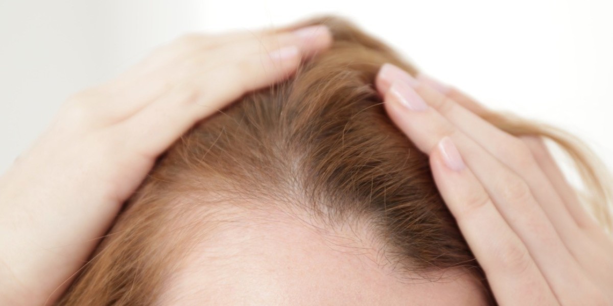 Success Stories with Finasteride for Hair Growth