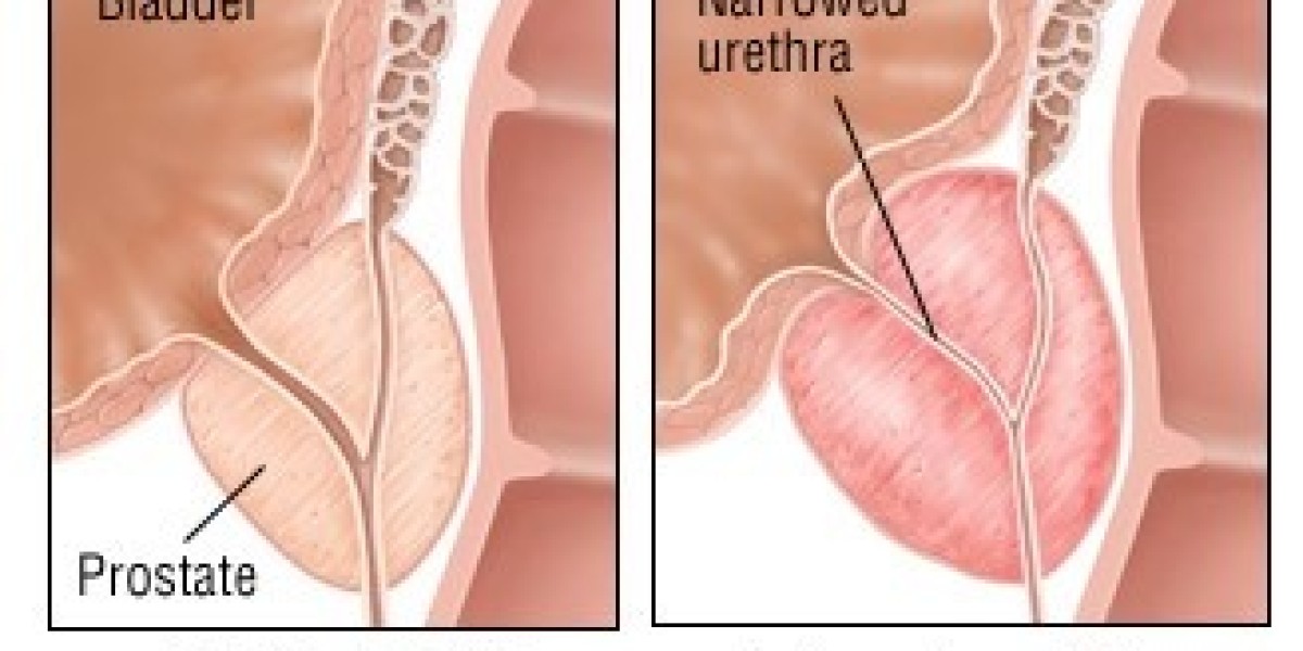 Prostate Health Market size See Incredible Growth during 2034