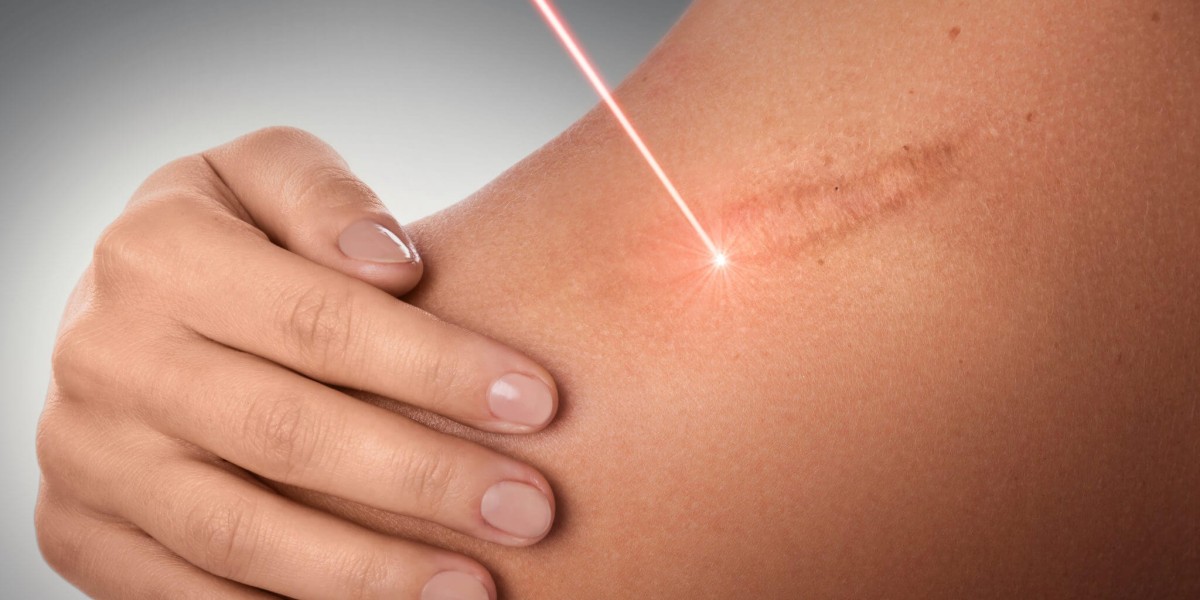 Benefits of Laser Scar Treatment: Riyadh Experts Share Insights