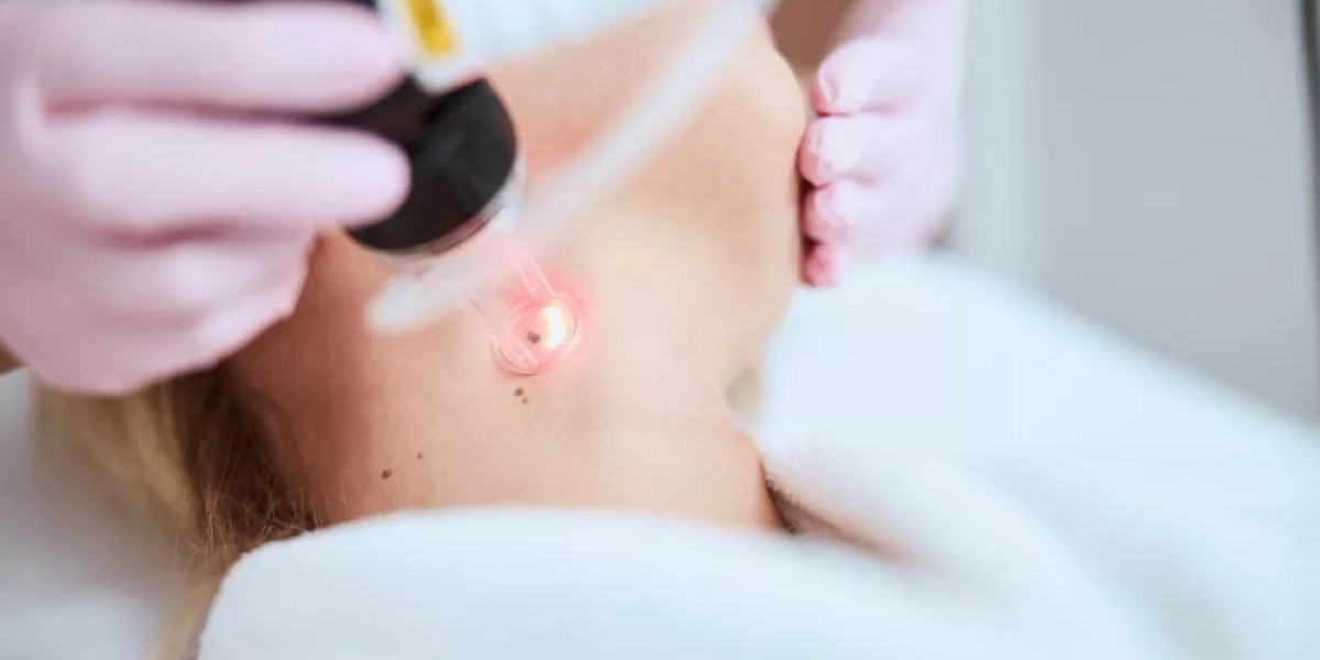 Do dermatologists remove skin tags?
