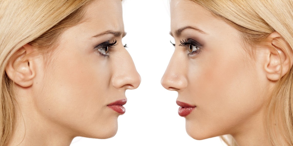 Choosing the Right Rhinoplasty Procedure in Dubai