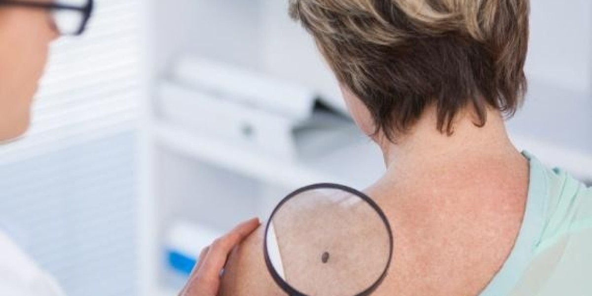 What's the best skin tag remover?