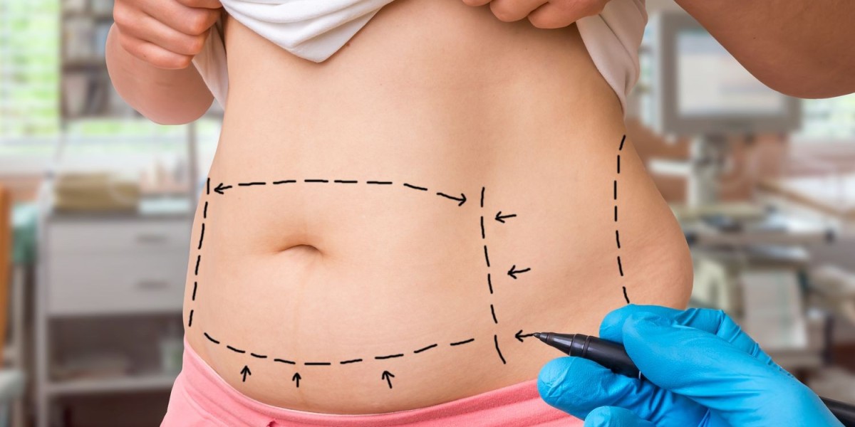 Scar Management After Tummy Tuck in Riyadh