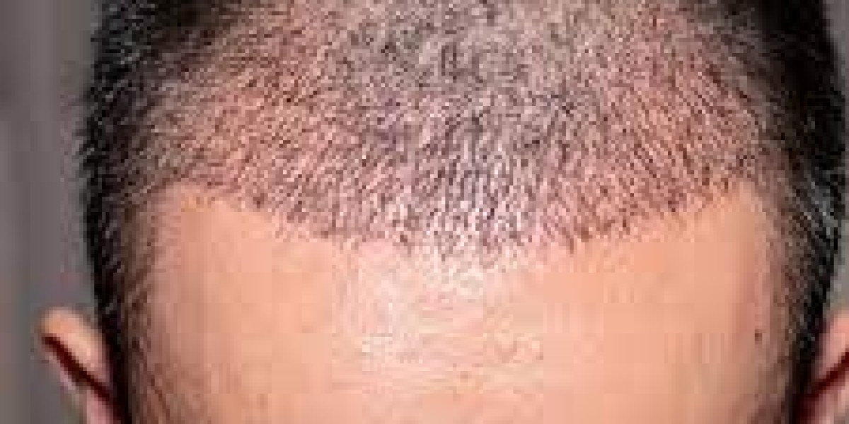 How Should I Care for My Scalp Post-Procedure?