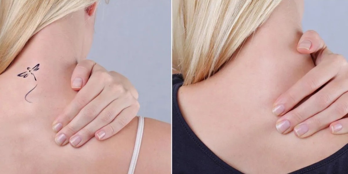 Minimize Treatment Time with Permanent Laser Tattoo Removal Dubai