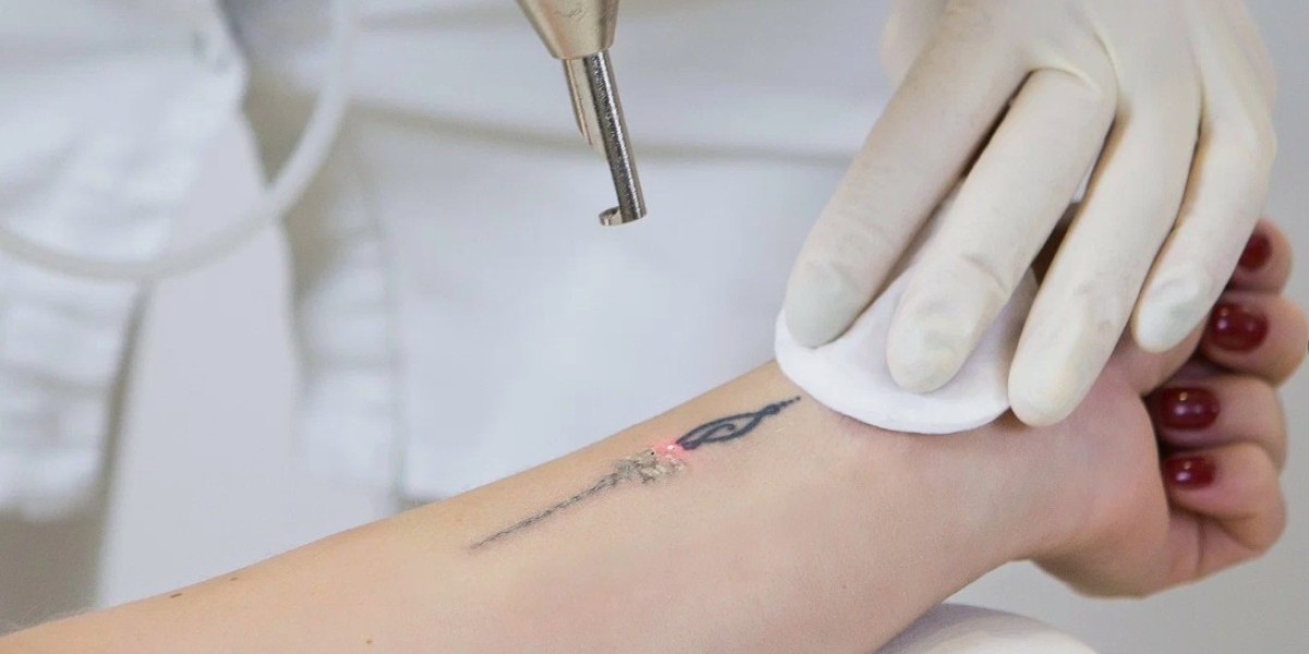 Professional and Discreet Tattoo Removal Services