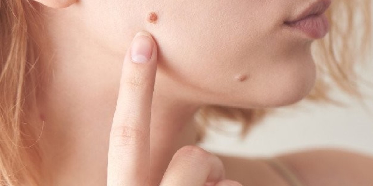 Warts Be Gone: Popular Treatments in Dubai