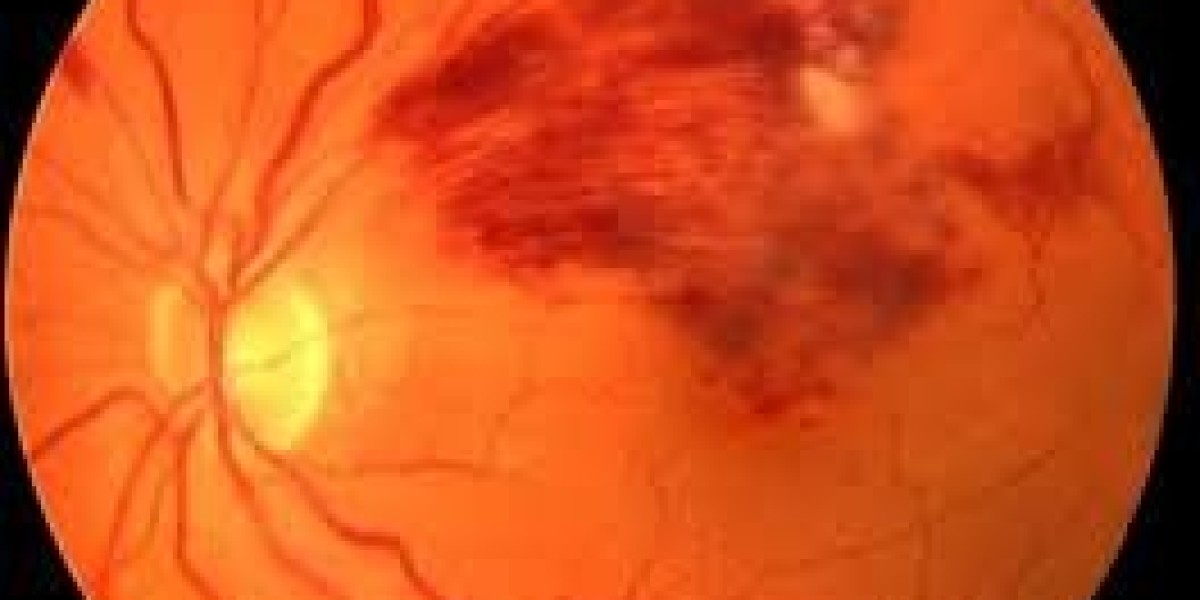 Retinal Vein Occlusion Treatment Innovations: The Future of Anti-VEGF and Laser Therapies