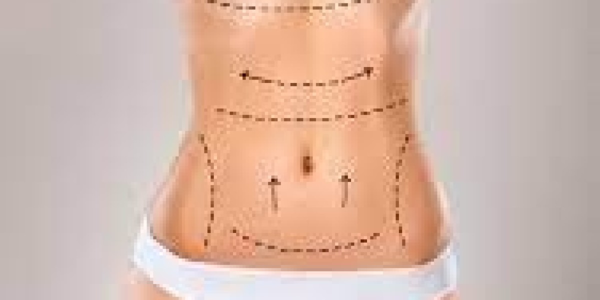 Expert Liposuction in Riyadh: Safe, Effective, and Life-Changing
