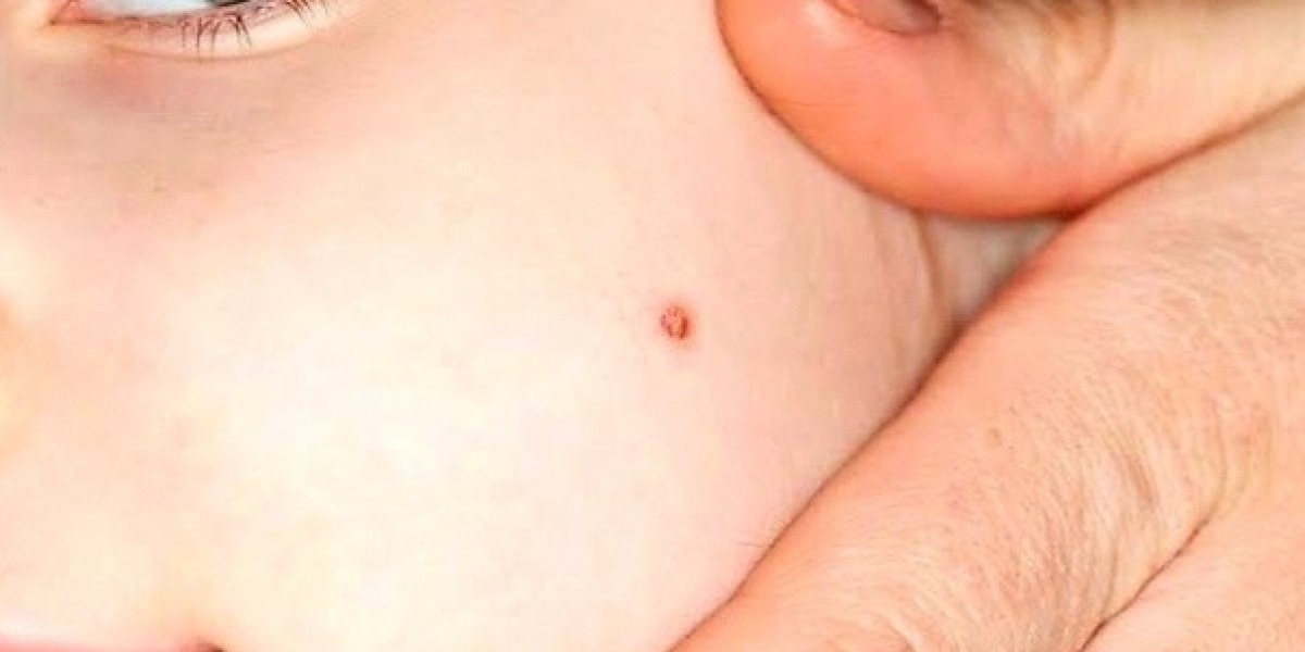 Permanent Wart Removal Methods in Dubai