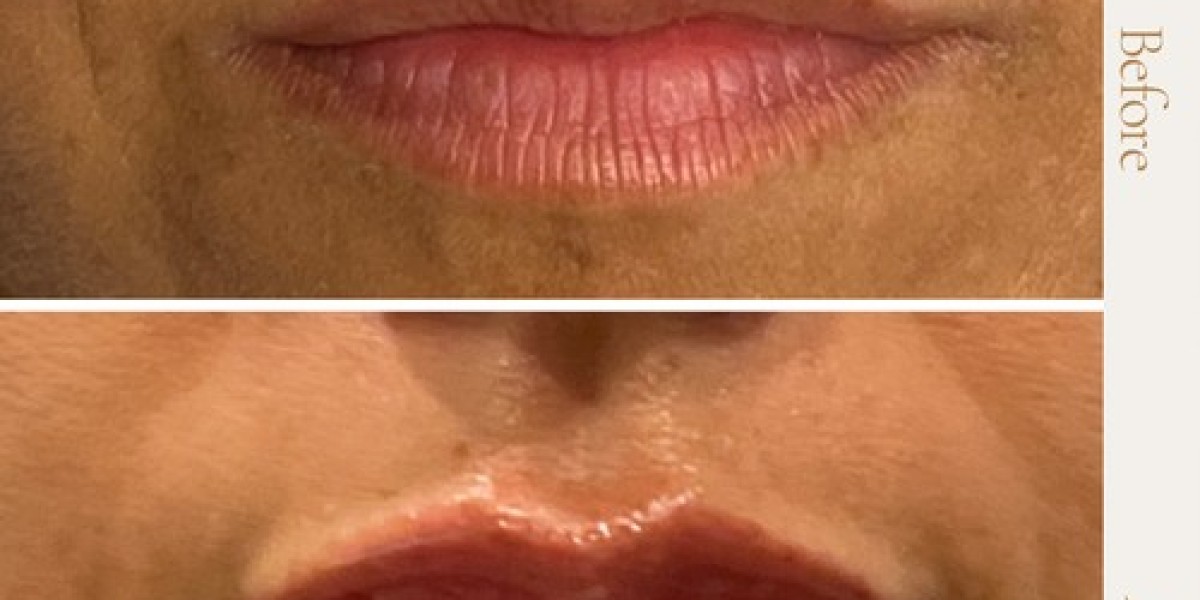 What You Need to Know About the Lakewood Lip Flip Procedure