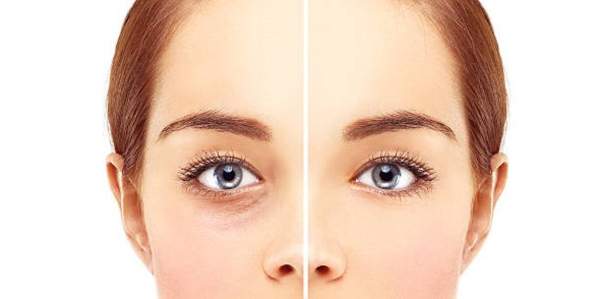 Get the Best Results with Blepharoplasty in Riyadh