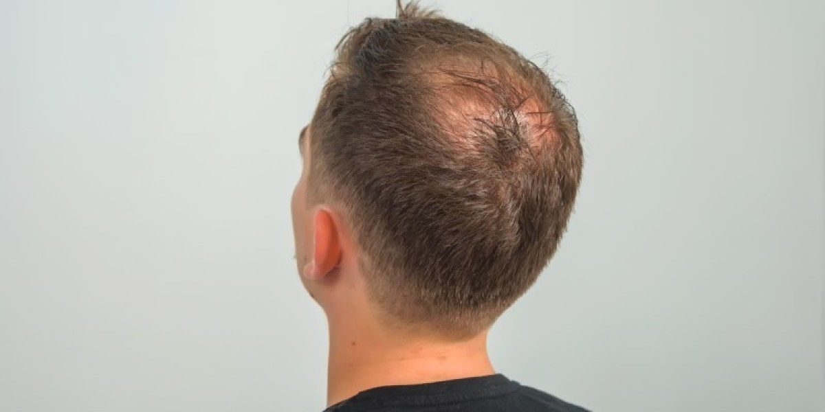 Can Finasteride for Hair Loss Prevent Further Thinning?