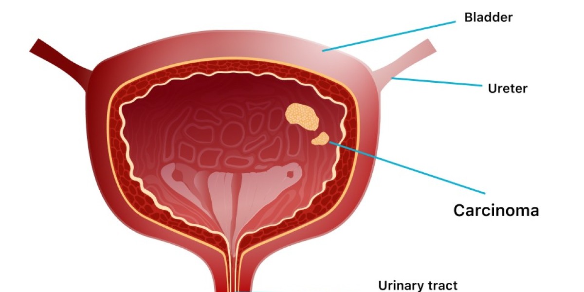 Urothelial Carcinoma Drug Pipeline Analysis