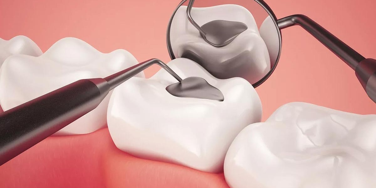 Dental Sealants Market: The Accelerating Factors Behind Market Expansion