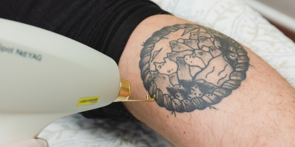Get a Fresh Start: Dubai’s Best Laser Tattoo Removal Service