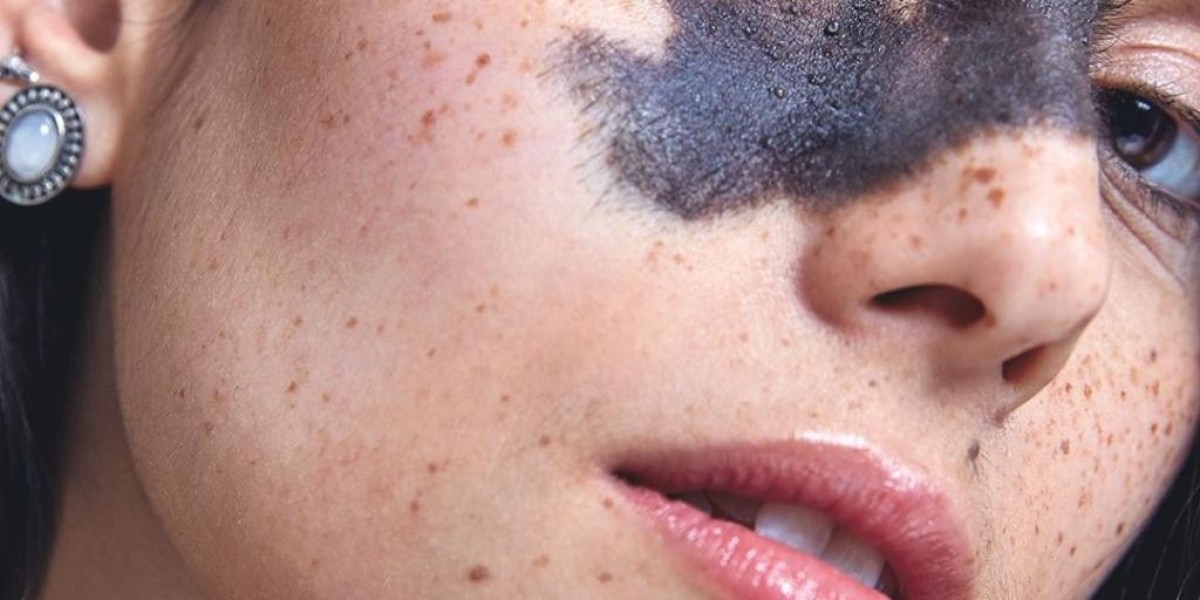 Birthmark Removal Success Stories Riyadh Clinics Review