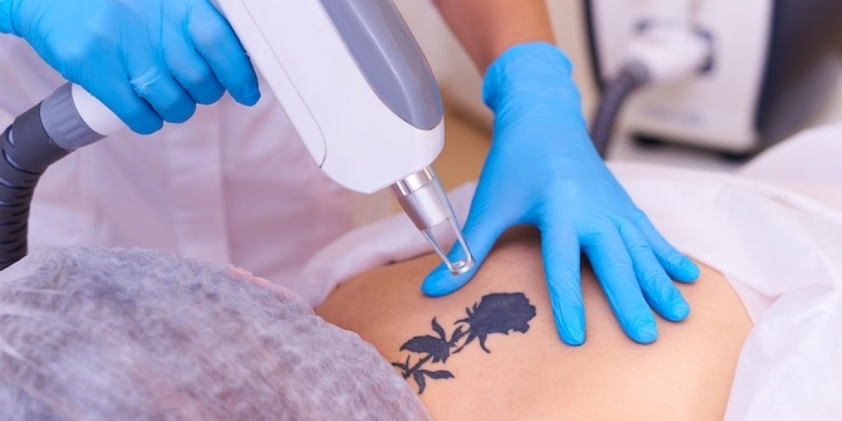  Laser Tattoo Removal in Dubai
