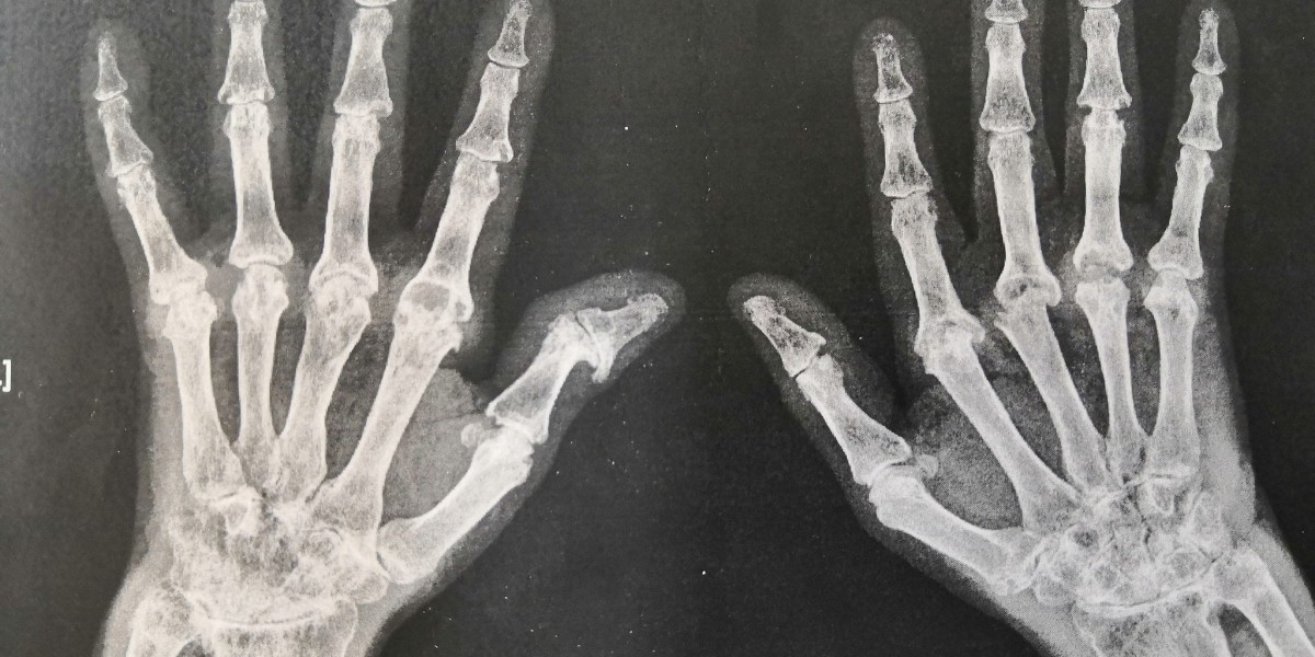 Arthritis Therapeutics Market: Unlocking Potential with Innovative Therapies and Digital Health Solutions