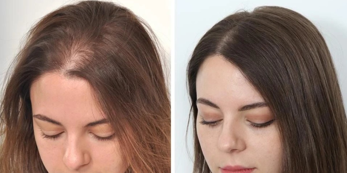 Can Women Benefit from Hair Transplant Procedures?