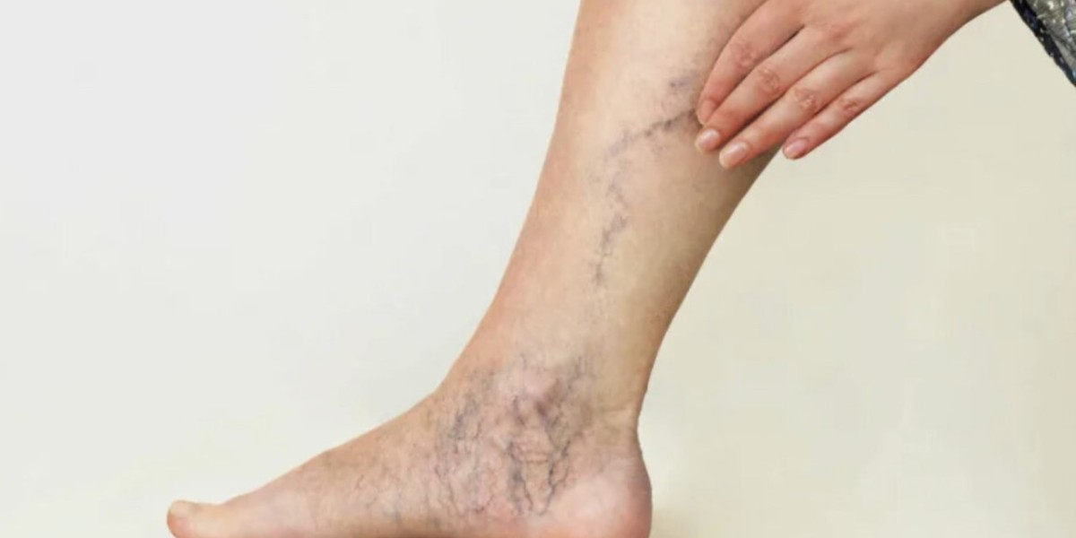 Varicose Veins Treatment in Riyadh: Before and After Results