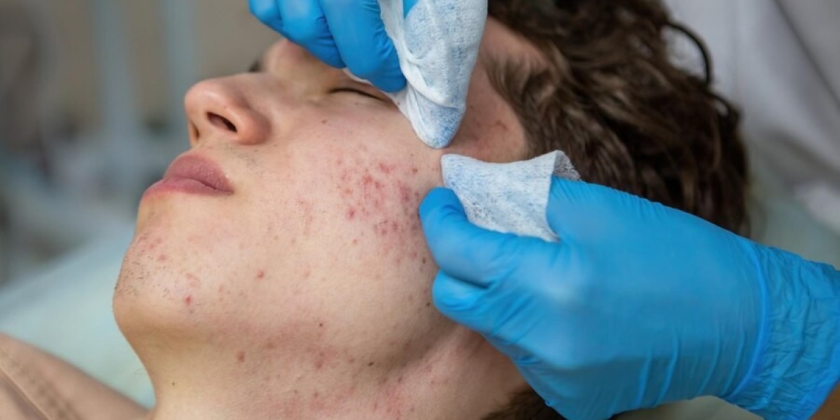 Emerging Trends in Post-Acne Scar Treatment: Market Growth and Forecasts To 2033