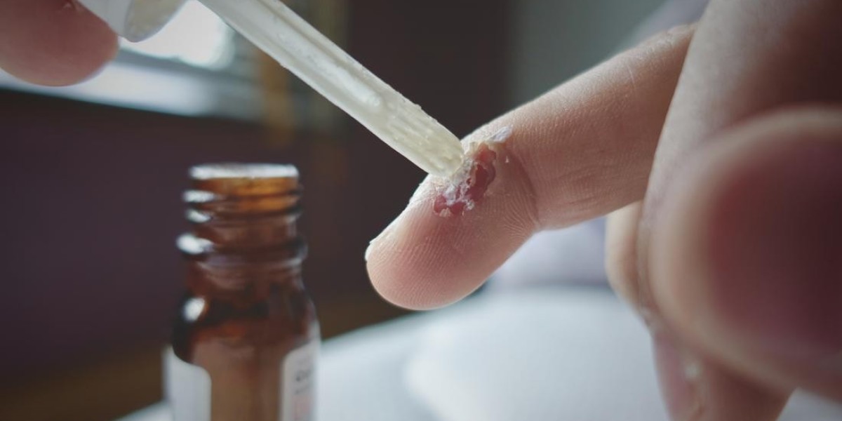 Best Wart Removal Kits You Can Buy Today