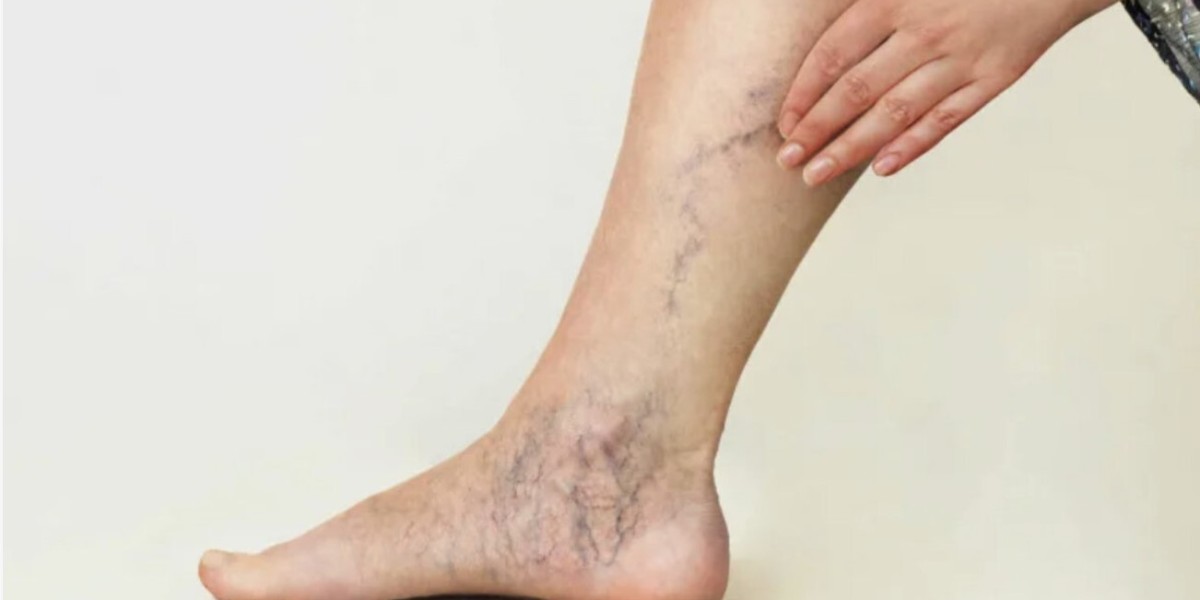 Spider Veins and Their Treatments: Your Riyadh Options